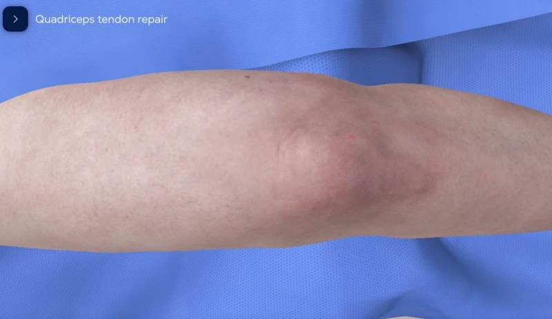 Quadriceps tendon repair