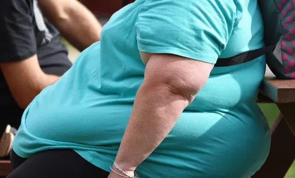 Como a obesidade afeta o desenvolvimento e tratamento das varizes?