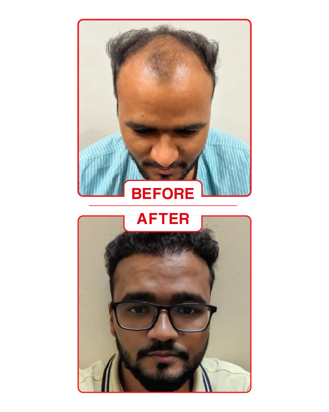 hair traansplant Goa