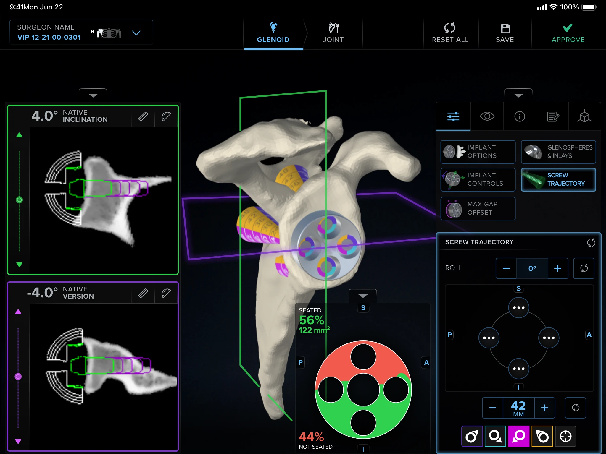 The VR-based planning tool in use, headset view or a surgeon using it to plan a case