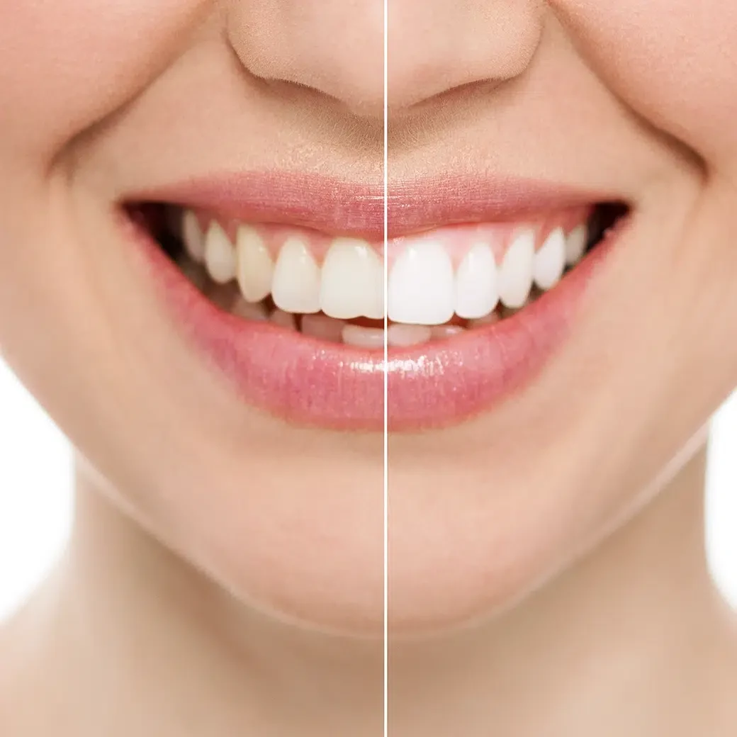 Teeth whitening treatment at COSDENT Smile Design