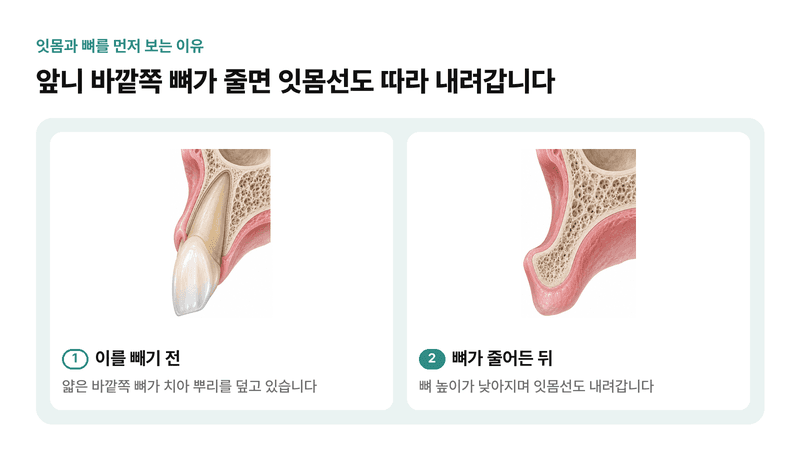 앞니 바깥쪽 뼈가 얇아 이를 뺀 뒤 뼈가 줄면 잇몸선도 함께 내려가는 과정을 옆 단면으로 비교한 일러스트