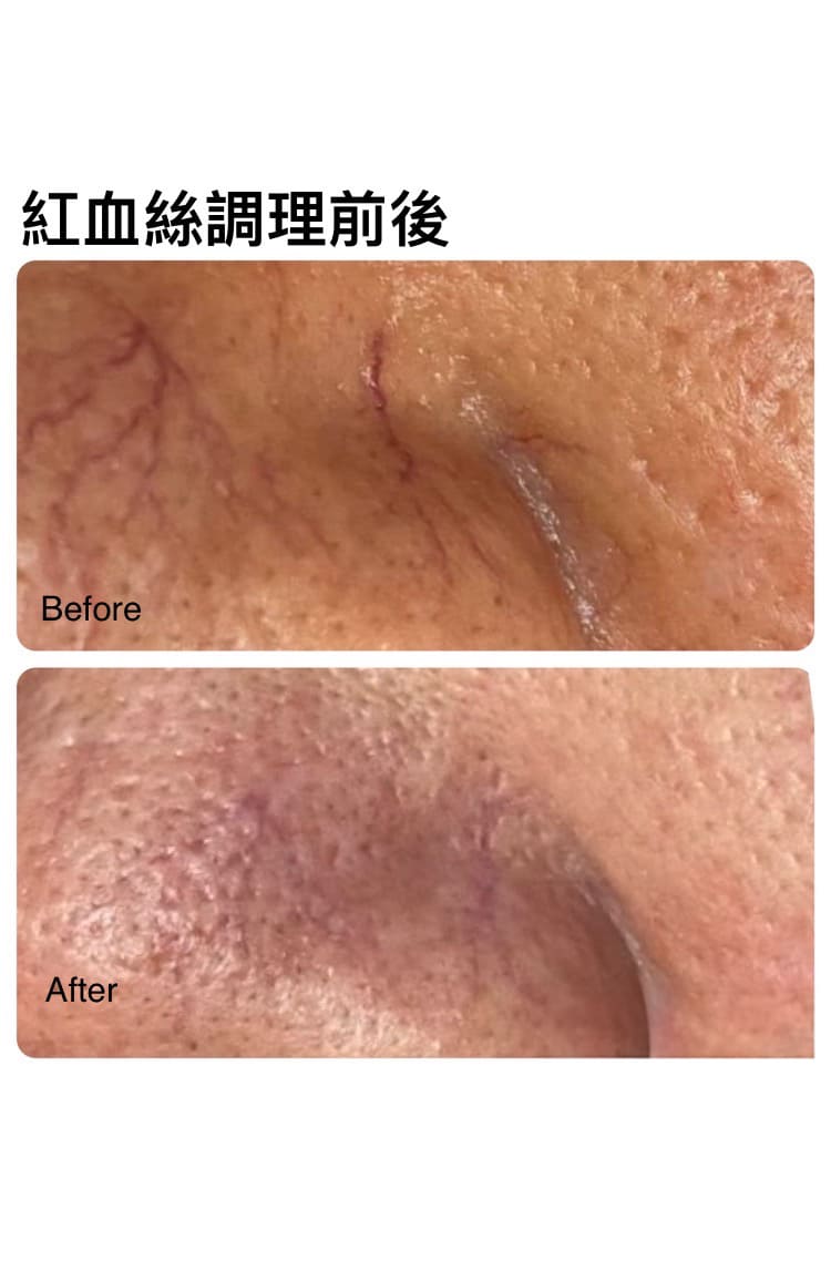 紅血絲調理前後