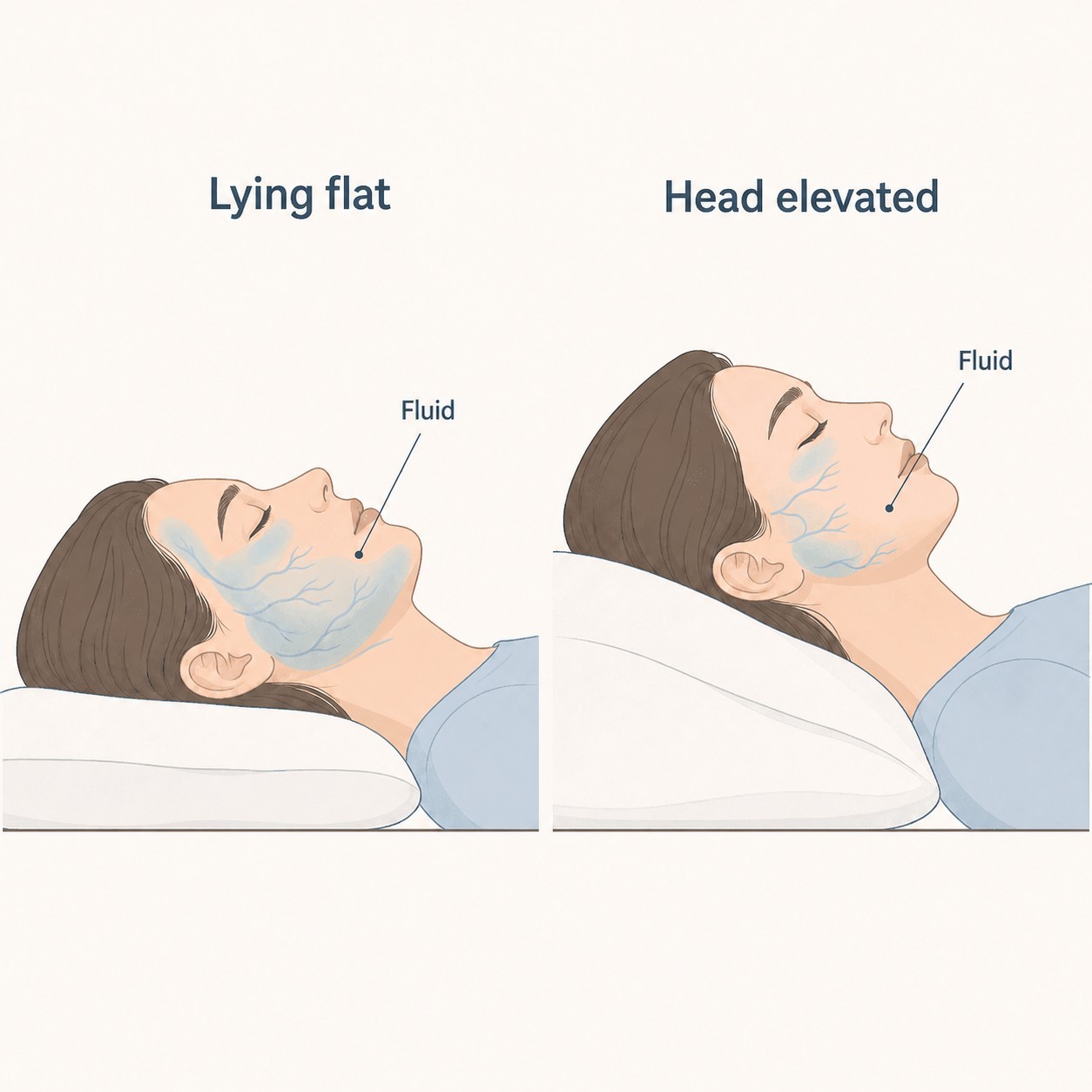 The difference in facial fluid when lying flat versus with the head elevated
