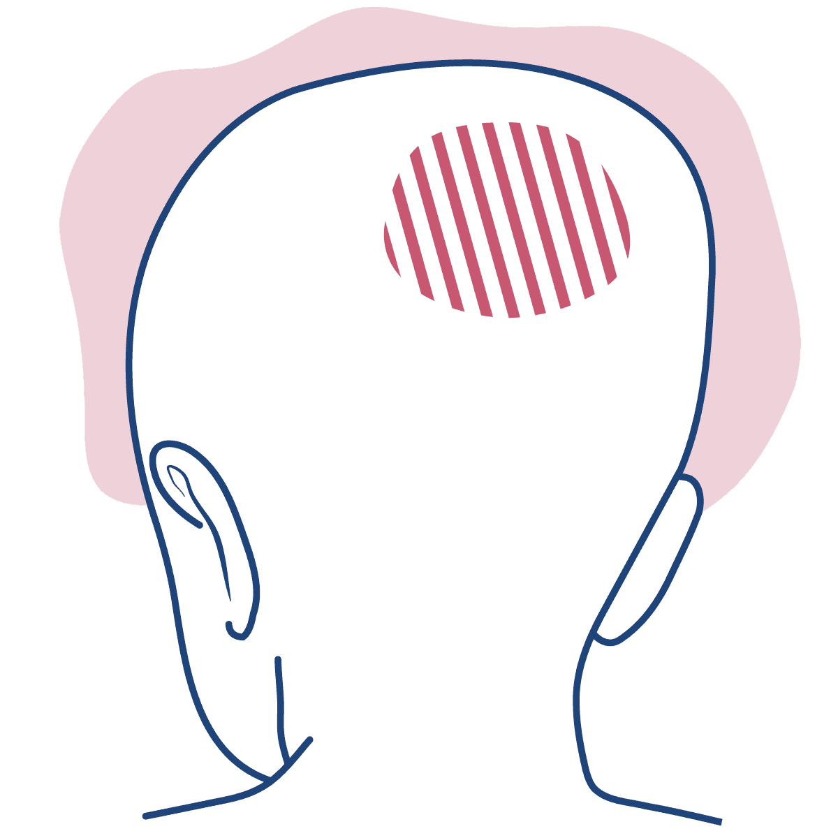 Ilustração mostra a cabeça de uma criança vista por trás em linhas azuis, com uma mancha rajada em tom de rosa escuro, ilustrando um tumor cerebral intracraniano.