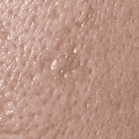 모공과 모공에 생긴 흉터 |  합정피부과 뷰티스톤의원