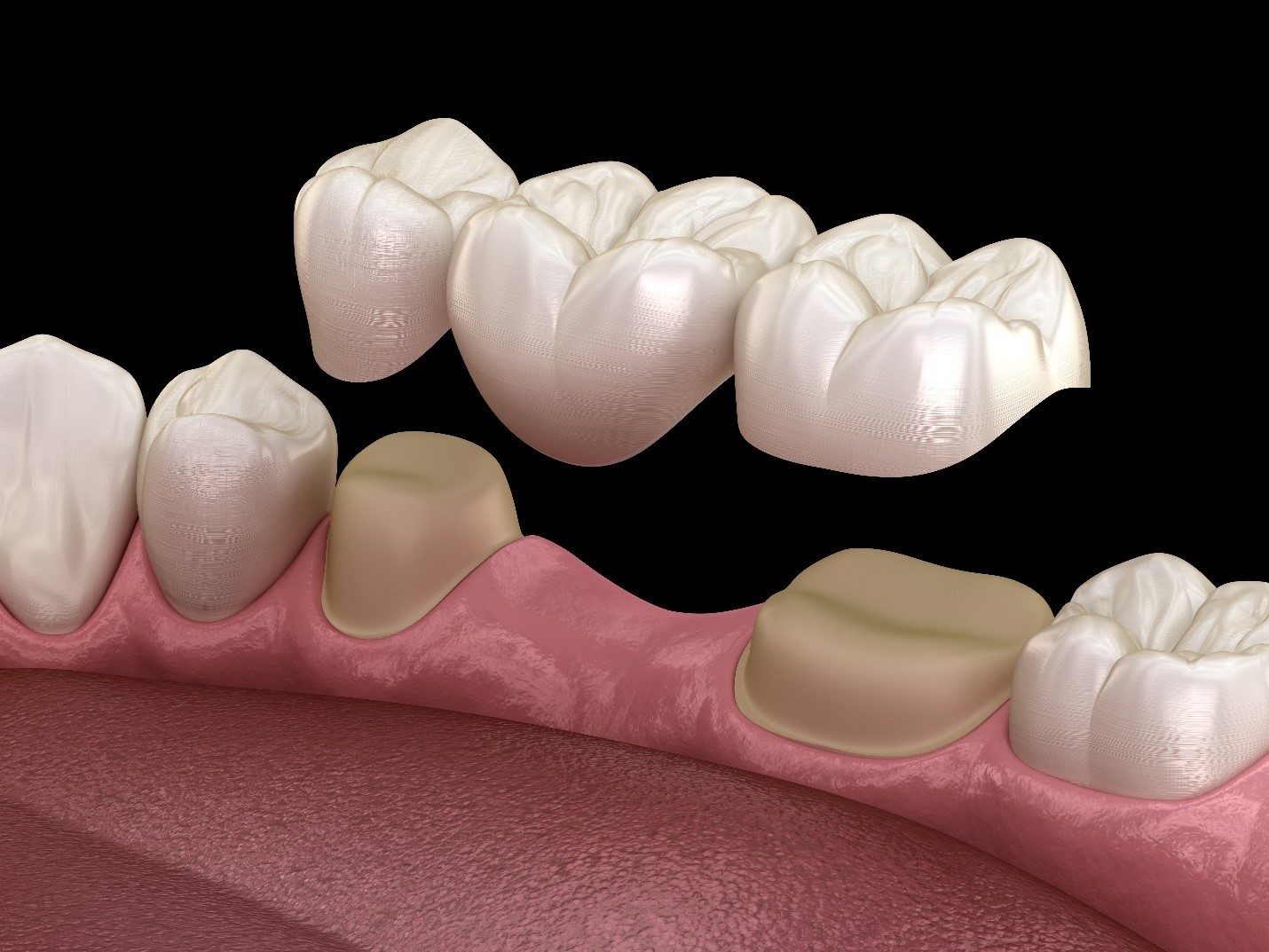 dental bridges