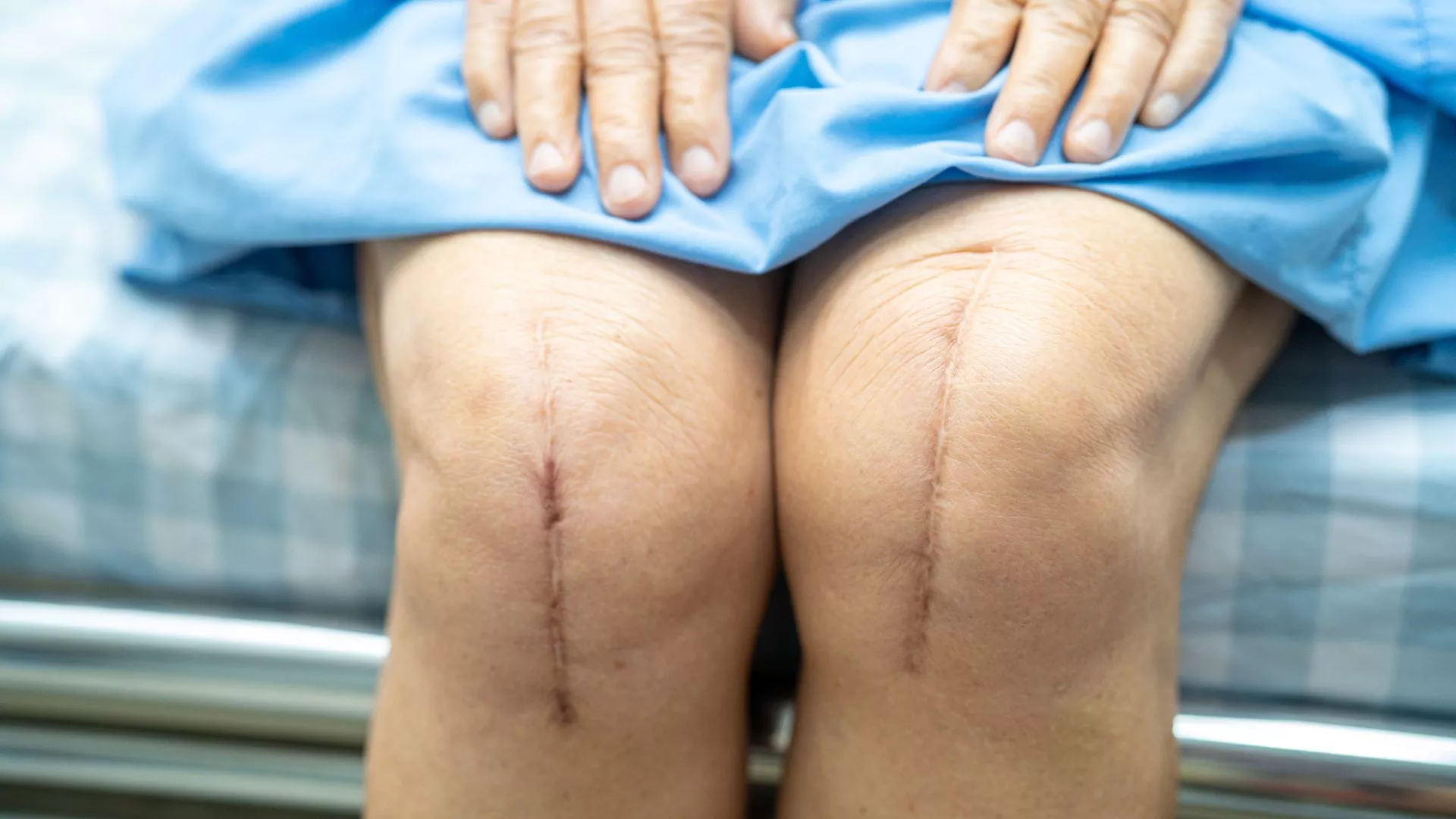 Close up shot of an individuals knees who has had total knee replacement surgeries, with fresh scarring present.