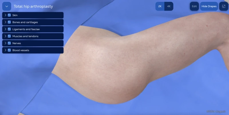 Total hip arthroplasty (uncemented) - posterior approach