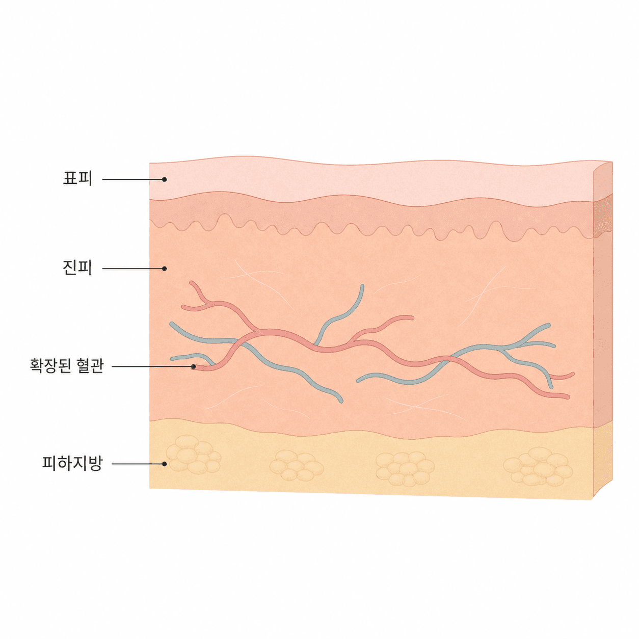 진피 속 확장된 혈관이 붉은기로 비쳐 보이는 피부 단면
