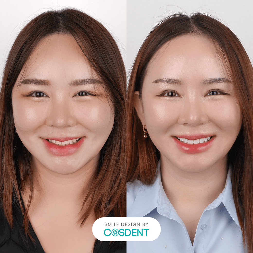 หน้ากลม ยิ้มกว้าง 16 ซี่