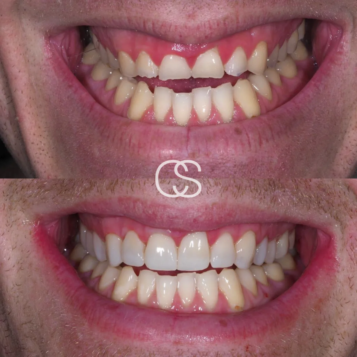 Before & After Teeth build ups at Colac Smiles, Colac