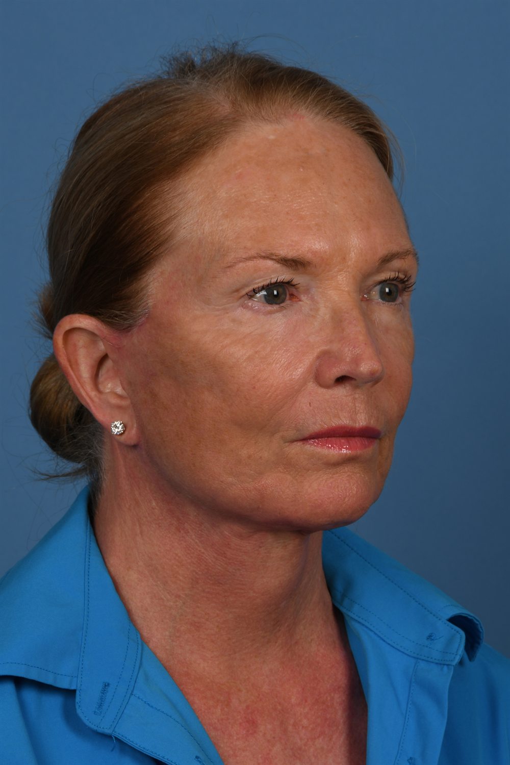 Facelift patient after surgery, three-quarter view, right side