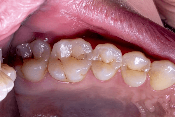 Tooth Colored Fillings