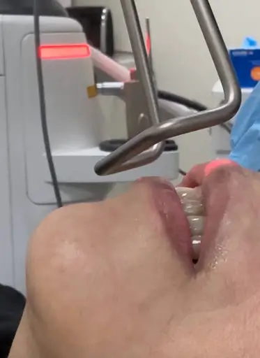 Fotona LipLase laser treatment applied to lips.