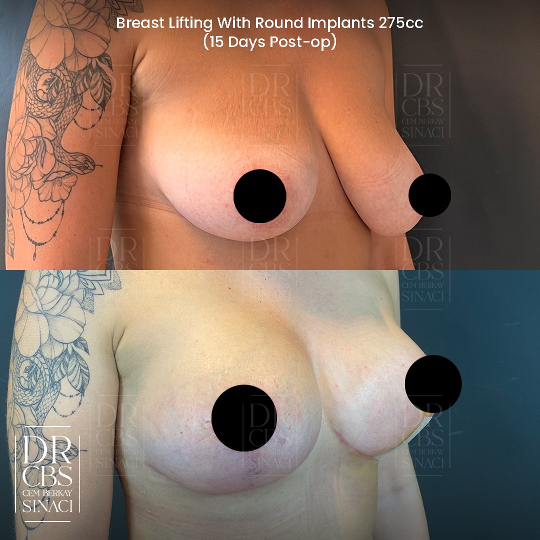 15 days result before after breast lift with implant mastopexy augmentation oblique view