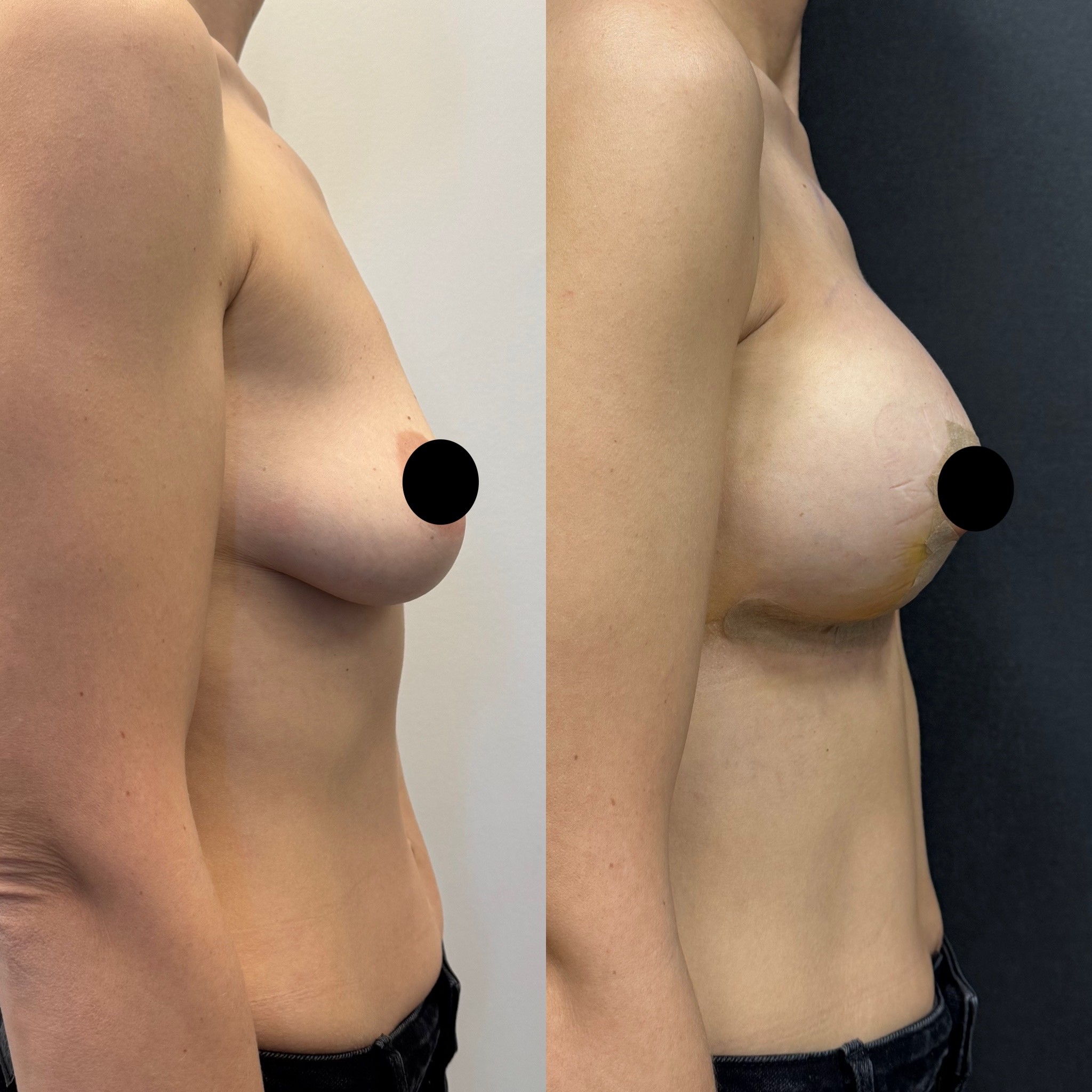 breast lift with implant before after photo 5 days post surgery side view