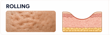Rolling scar