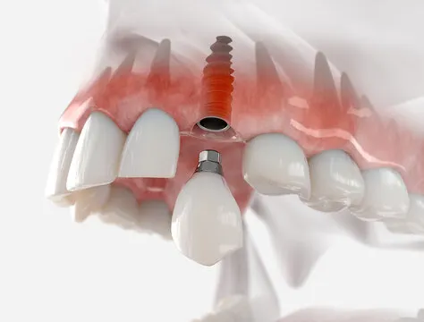 Intraoral Cameras