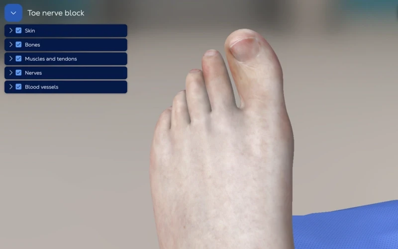Digital Nerve Block - Toe