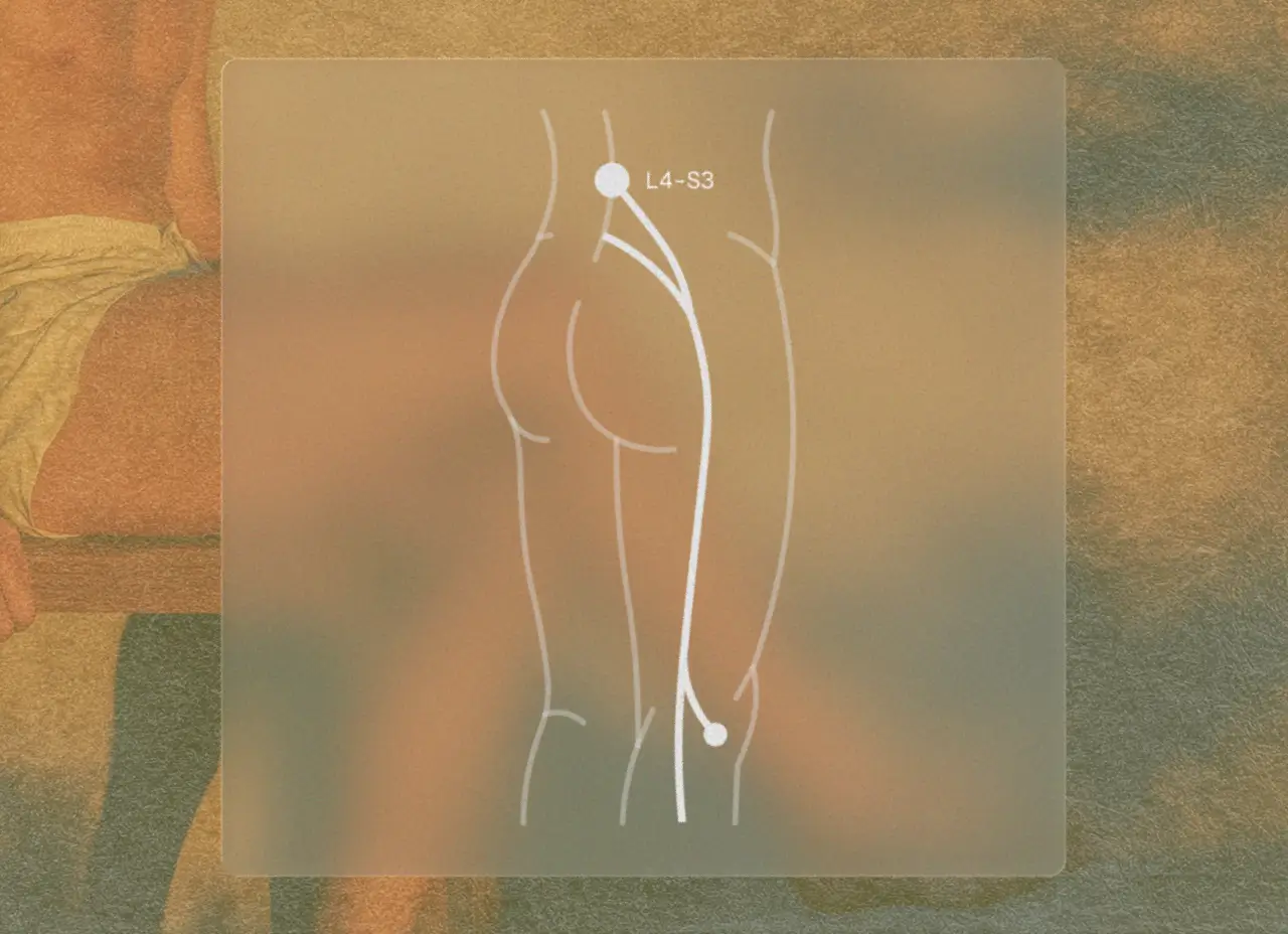 Sciatica Treatment Chart