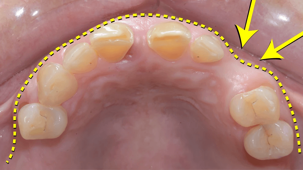 Botverlies na trekken van een voortand