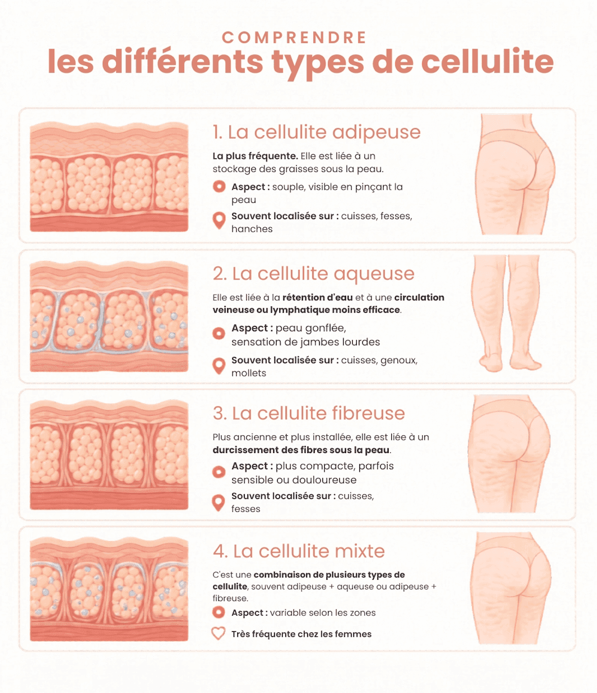 Infographie pédagogique expliquant les caractéristiques des 4 principaux types de cellulite (adipeuse, aqueuse, fibreuse et mixte) pour aider les femmes enceintes à mieux comprendre leur peau sans culpabiliser.