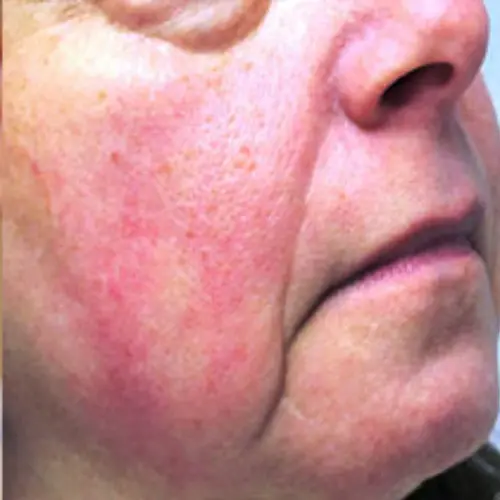 Before laser rosacea treatment at The Vancouver Aesthetician — visible facial redness and rosacea on skin