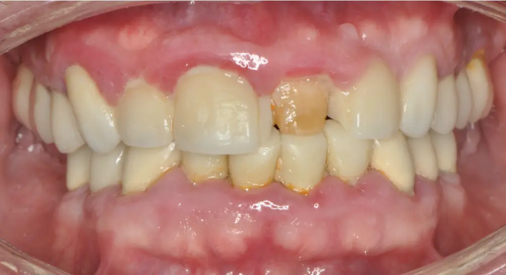Before ortho treatment