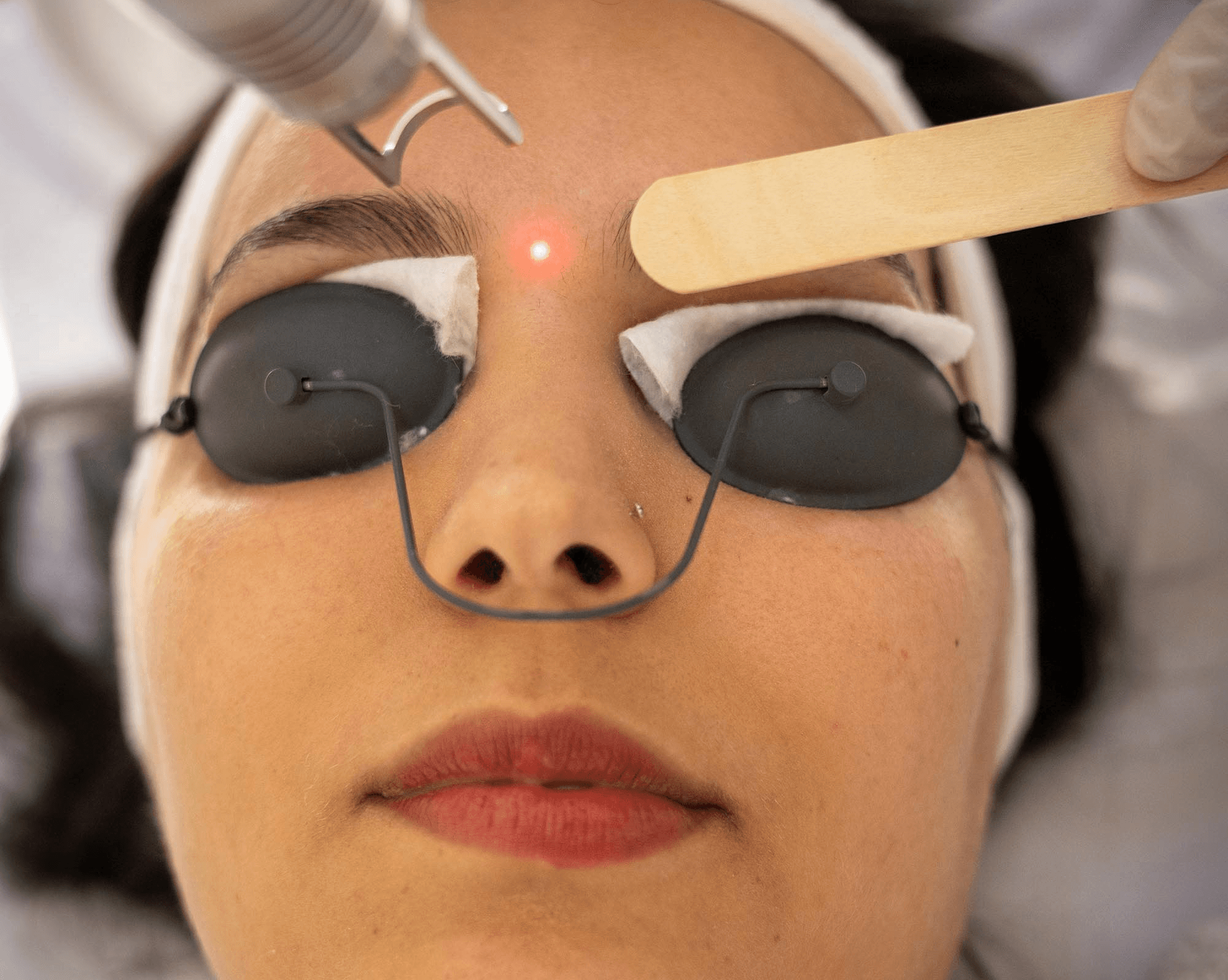 Aftercare tips of laser hair removal