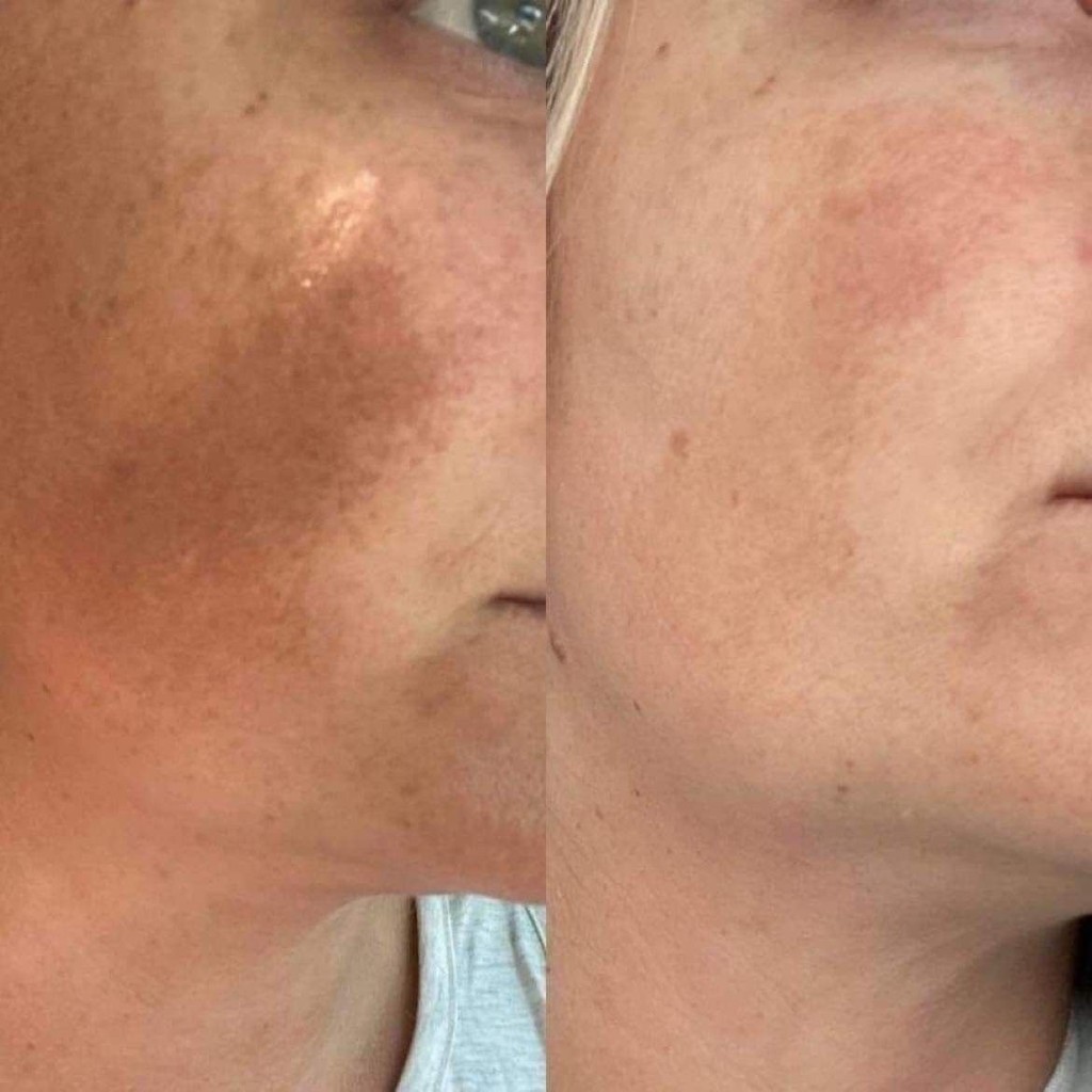 Collagen-boosting microneedling results for neck skin in Los Angeles.