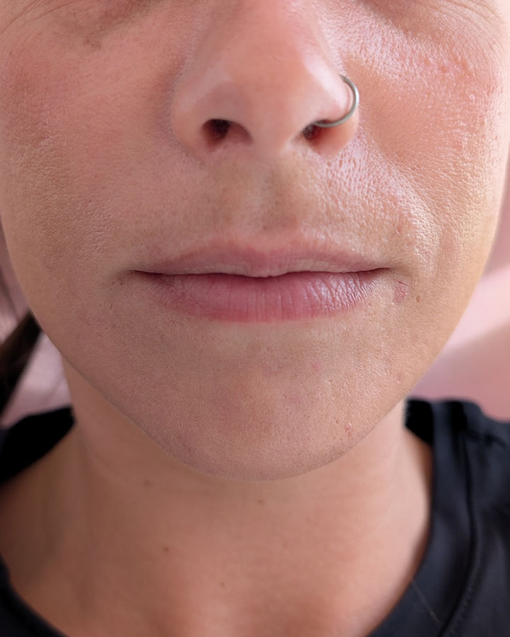 Menej výrazné a dehydrované pery pred ošetrením v klinike Esthea