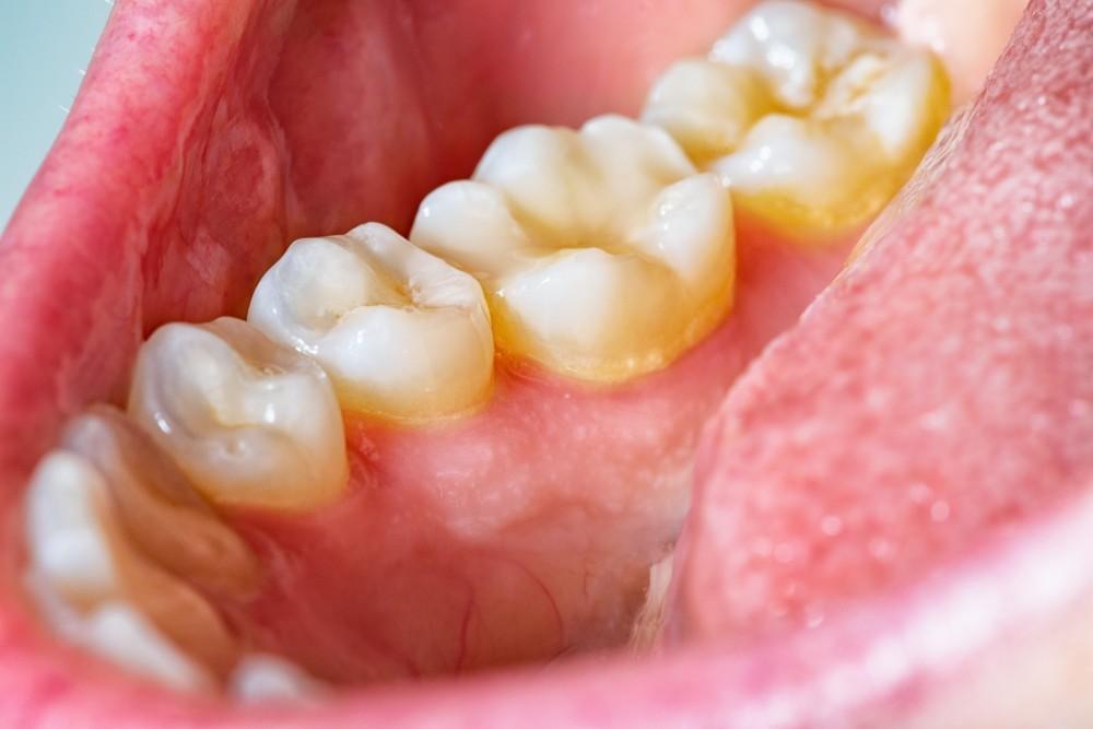 Dental Tartar