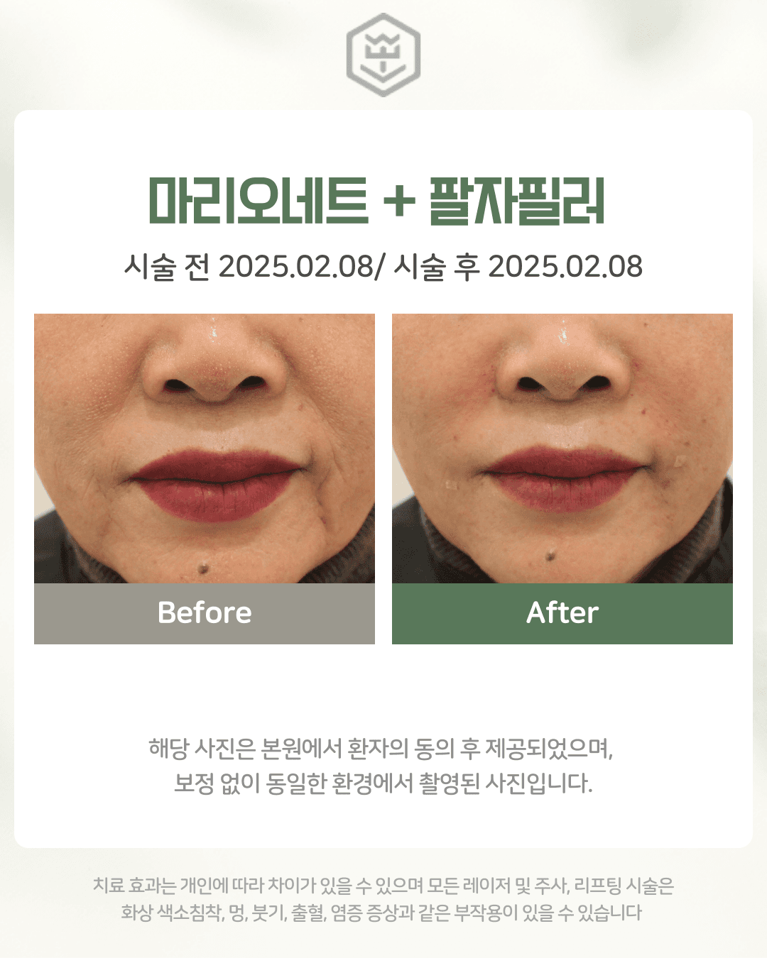 마리오네트+팔자필러