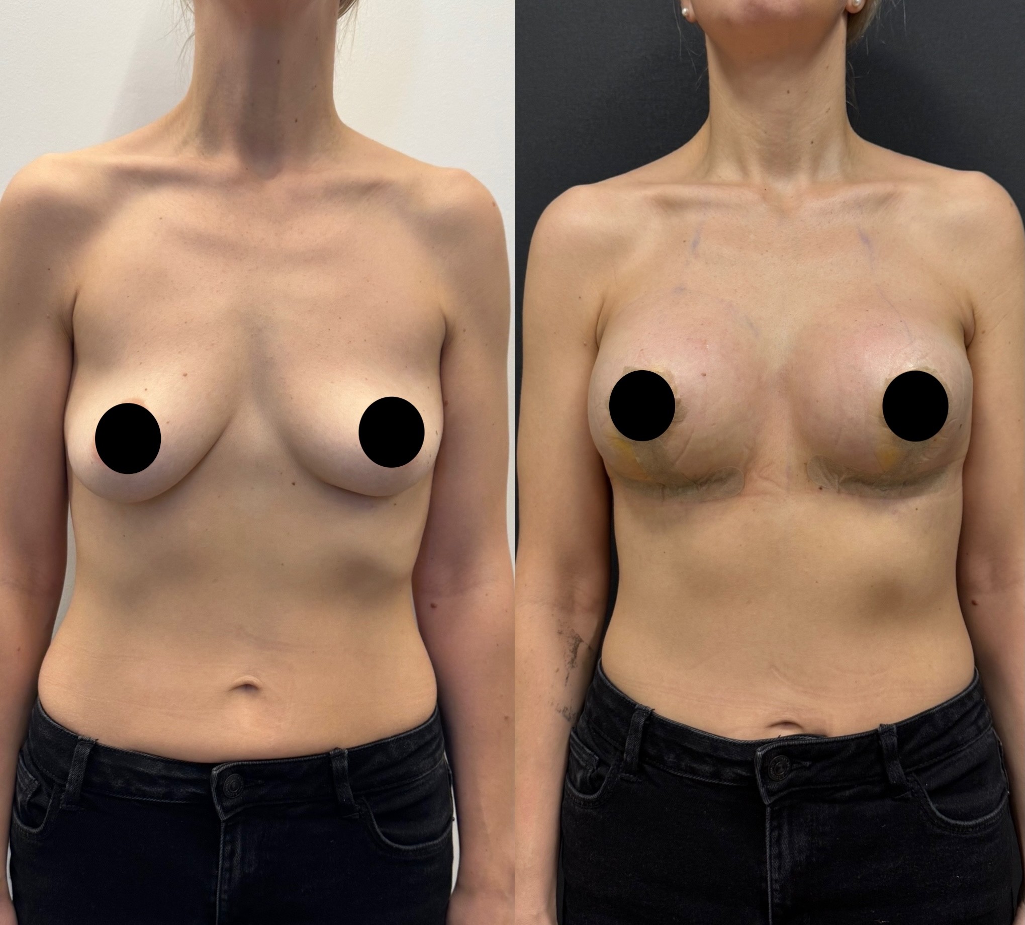 breast lift with implant before after photo 5 days post surgery front view