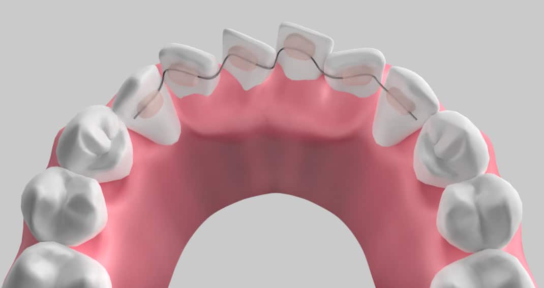 C5 Hidden Braces