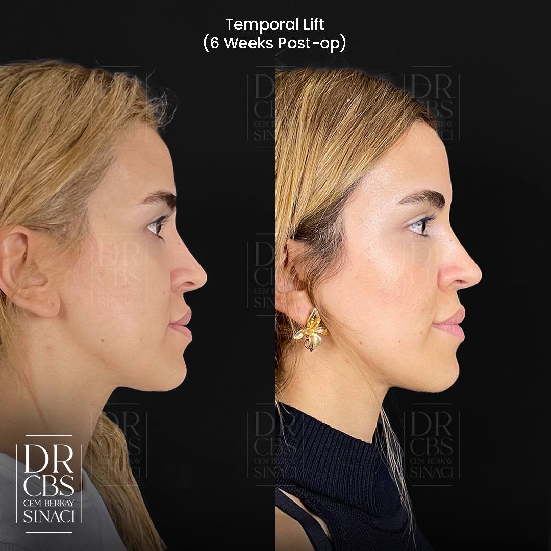 6 weeks post-op before after temporal lift - browlift and midfacelift side view