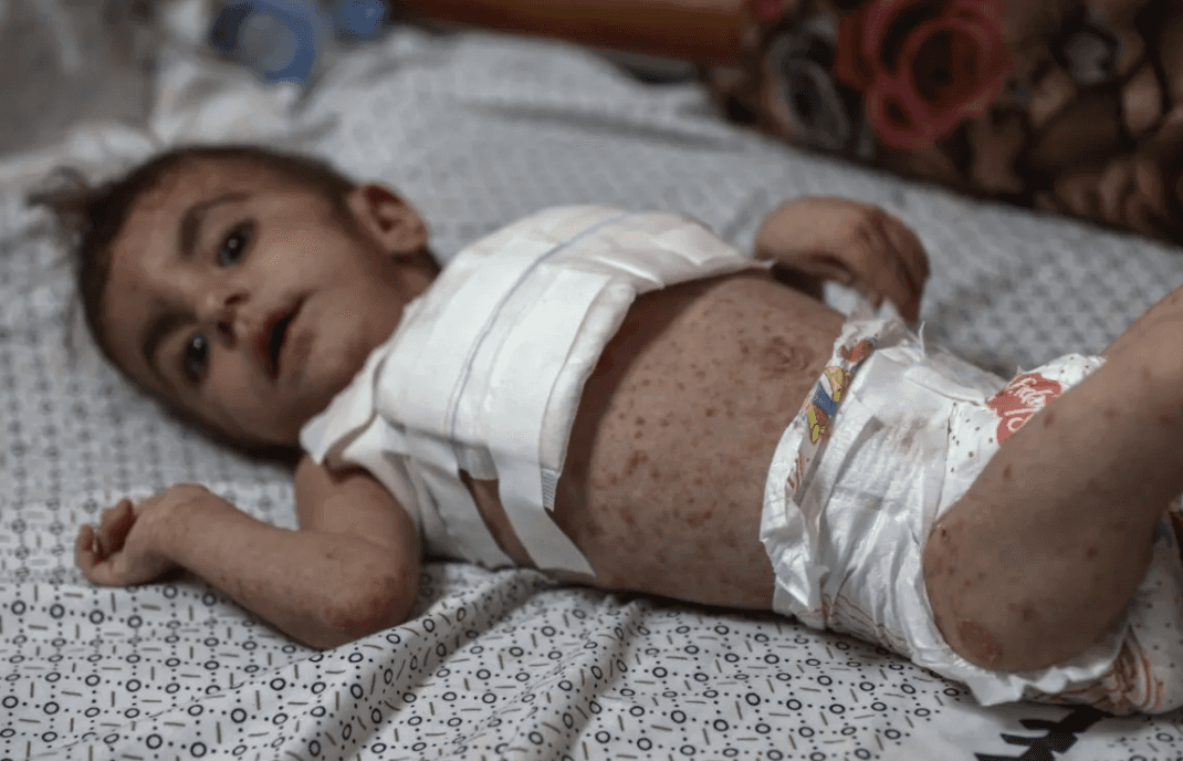 A Palestinian child with a skin infection in Kamal Adwan Hospital in Beit Lahiya, northern Gaza Strip