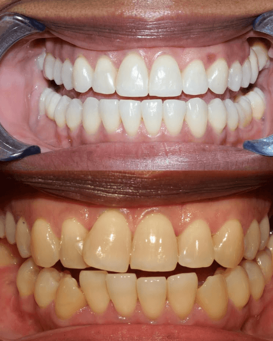 Whitening Treatment at ScarboroSmiles Before and After at ScarboroSmiles Dental Clinic in Scarborough, ON | Best dentist in Scarborough, ON.