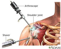 Shoulder arthroscopy surgery by Dr. Chandu Vamsi Krishna in Vizag