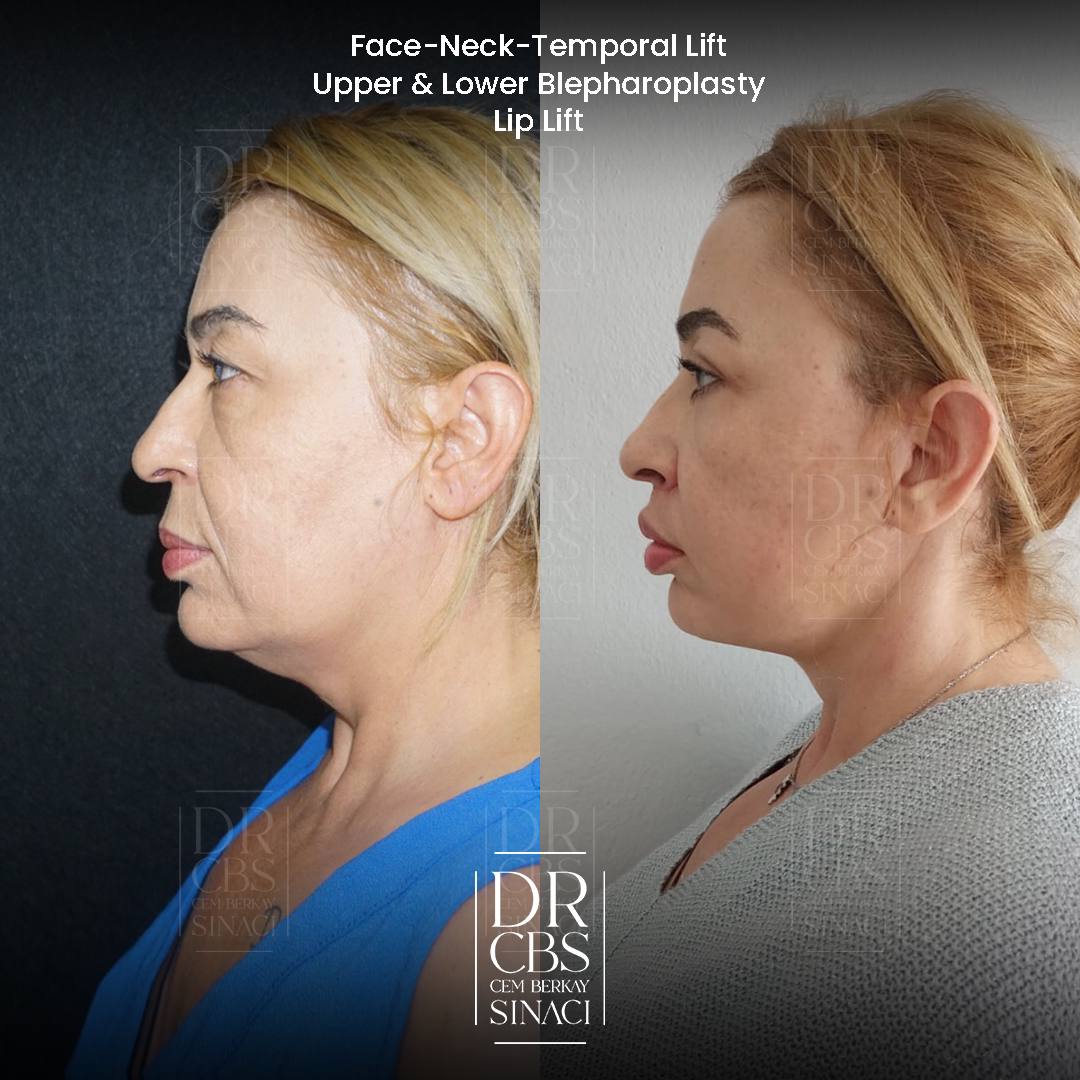 deep plane facelift and upper blepharoplasty 7 months post-op before after side view