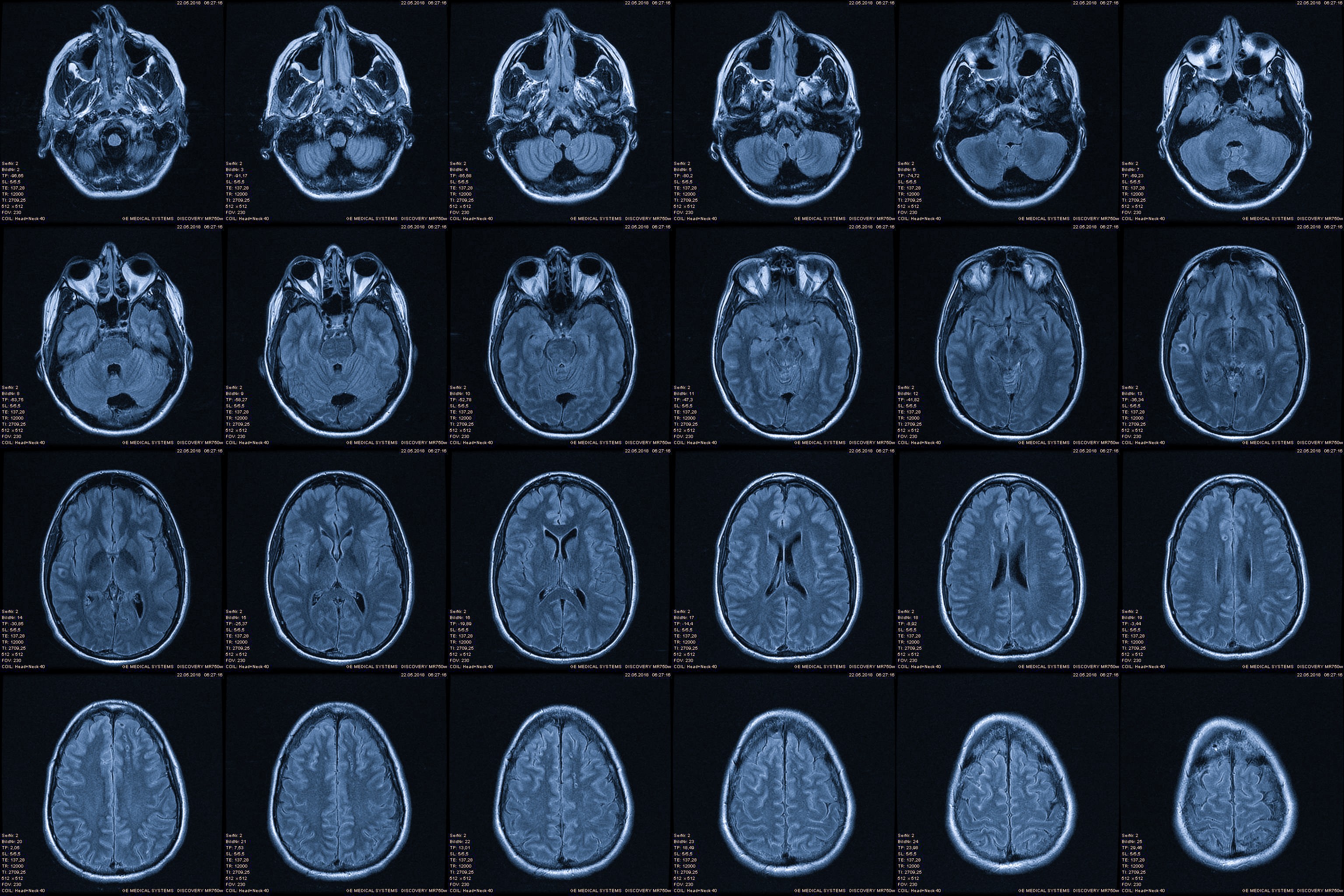 CT scan image of a brain