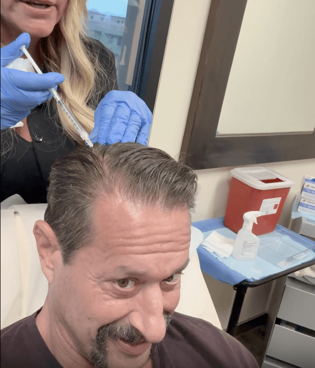 Renew Bio Aesthetics Stem Cell Hair Restoration Photo