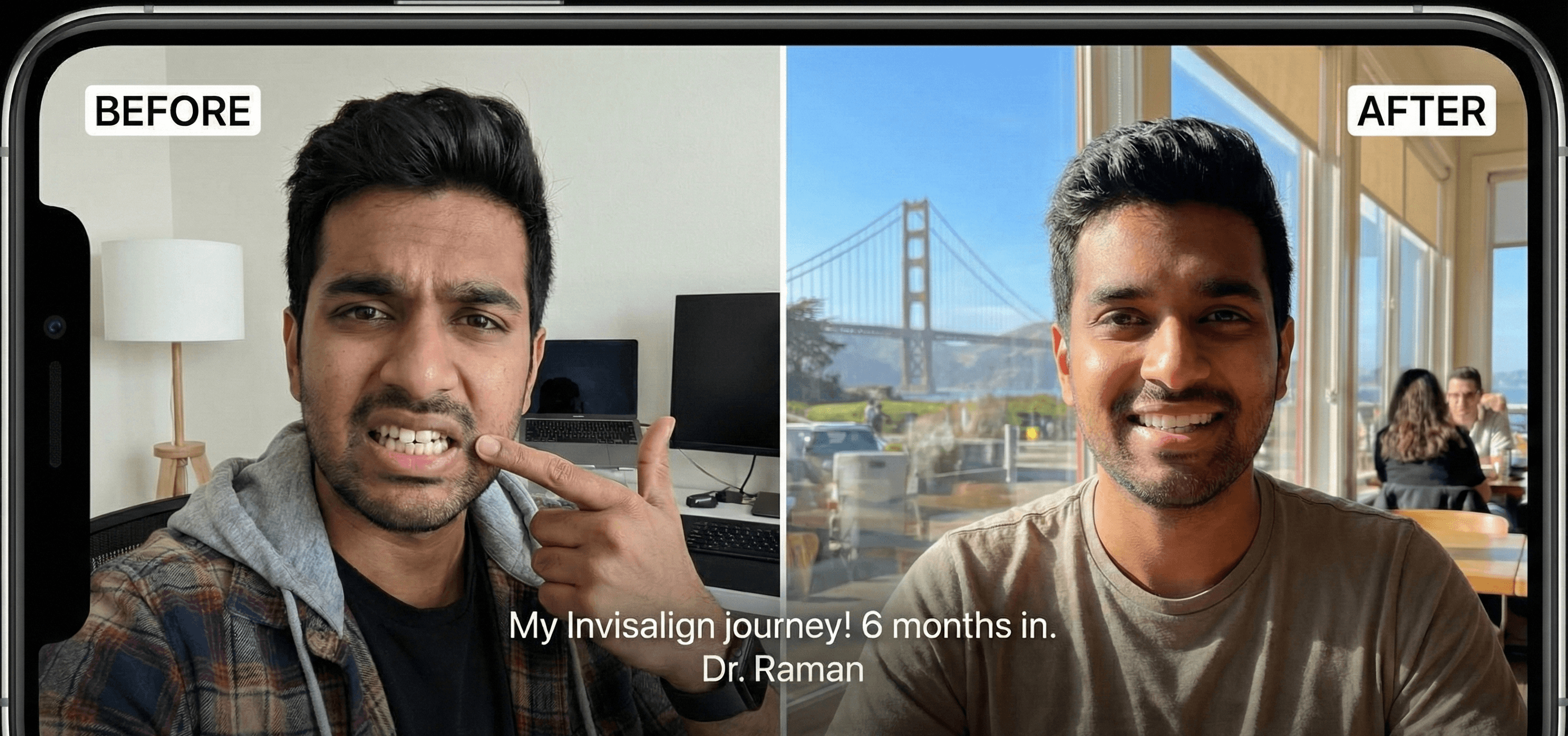 Close-up of teeth showing before-and-after whitening