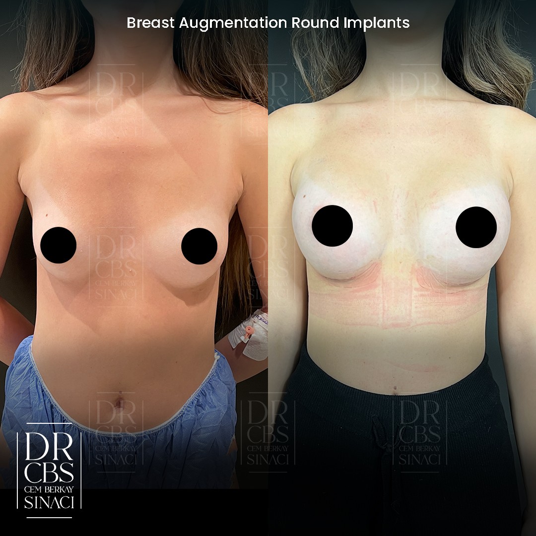 breast augmentation 2 weeks result front view