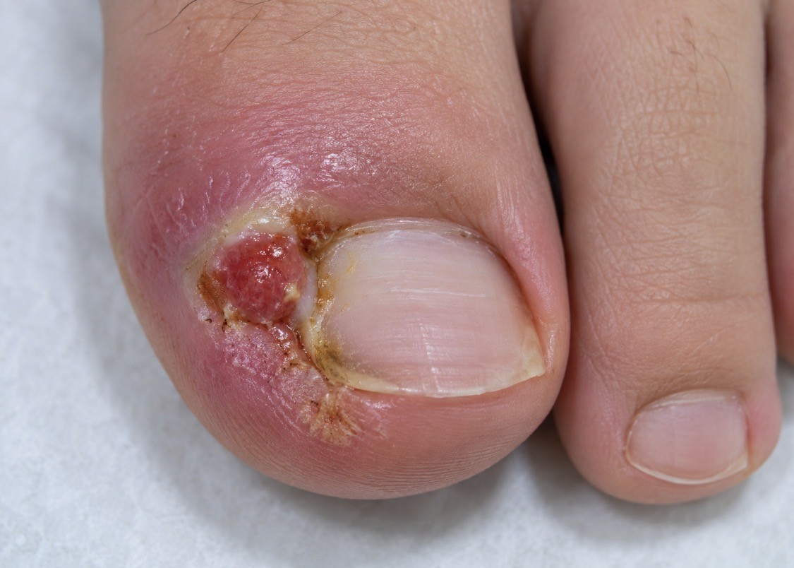 Recurrent ingrowing toenail with redness, swelling and hypergranulation tissue alongside the nail.