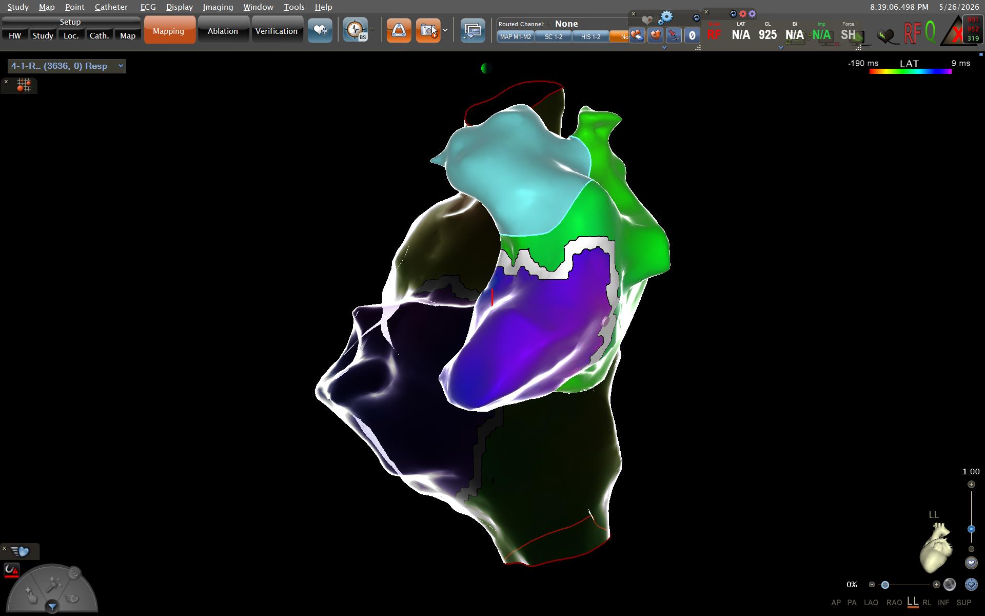 Mapeo 3D cardíaco con Cero Fluoroscopía en electrofisiología pediátrica