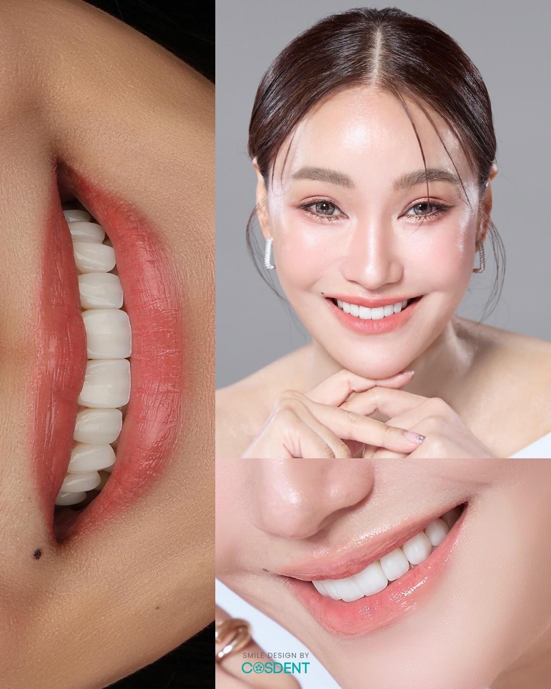 เคสทำวีเนียร์ หมอวรรณ cosdent