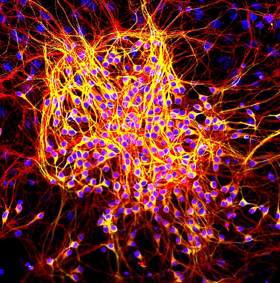 red and yellow trands with blue dots show tau proteins in the brain