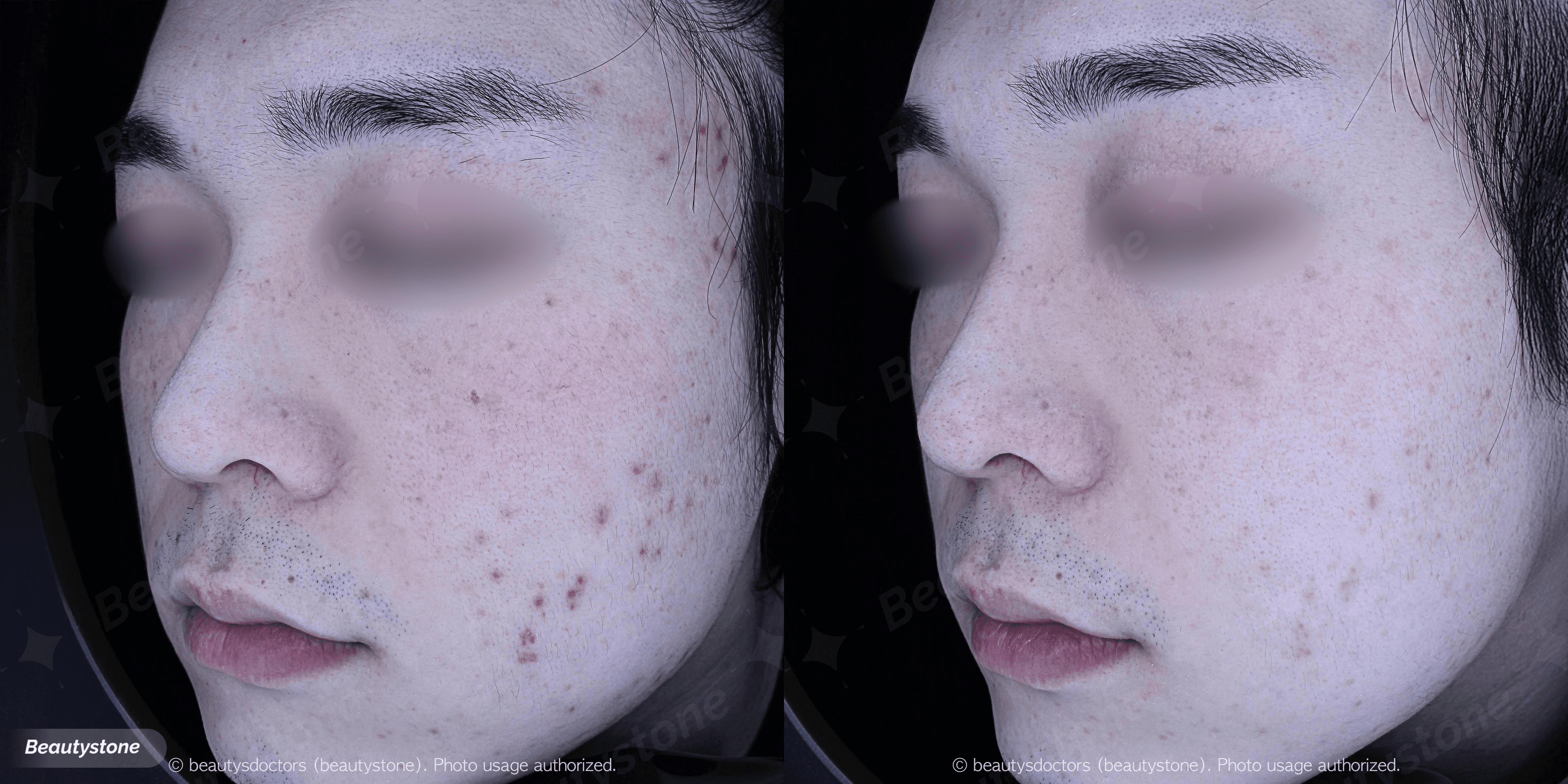 결혼 앞두고 여드름 흉터, 지금 치료해도 늦지 않을까요?